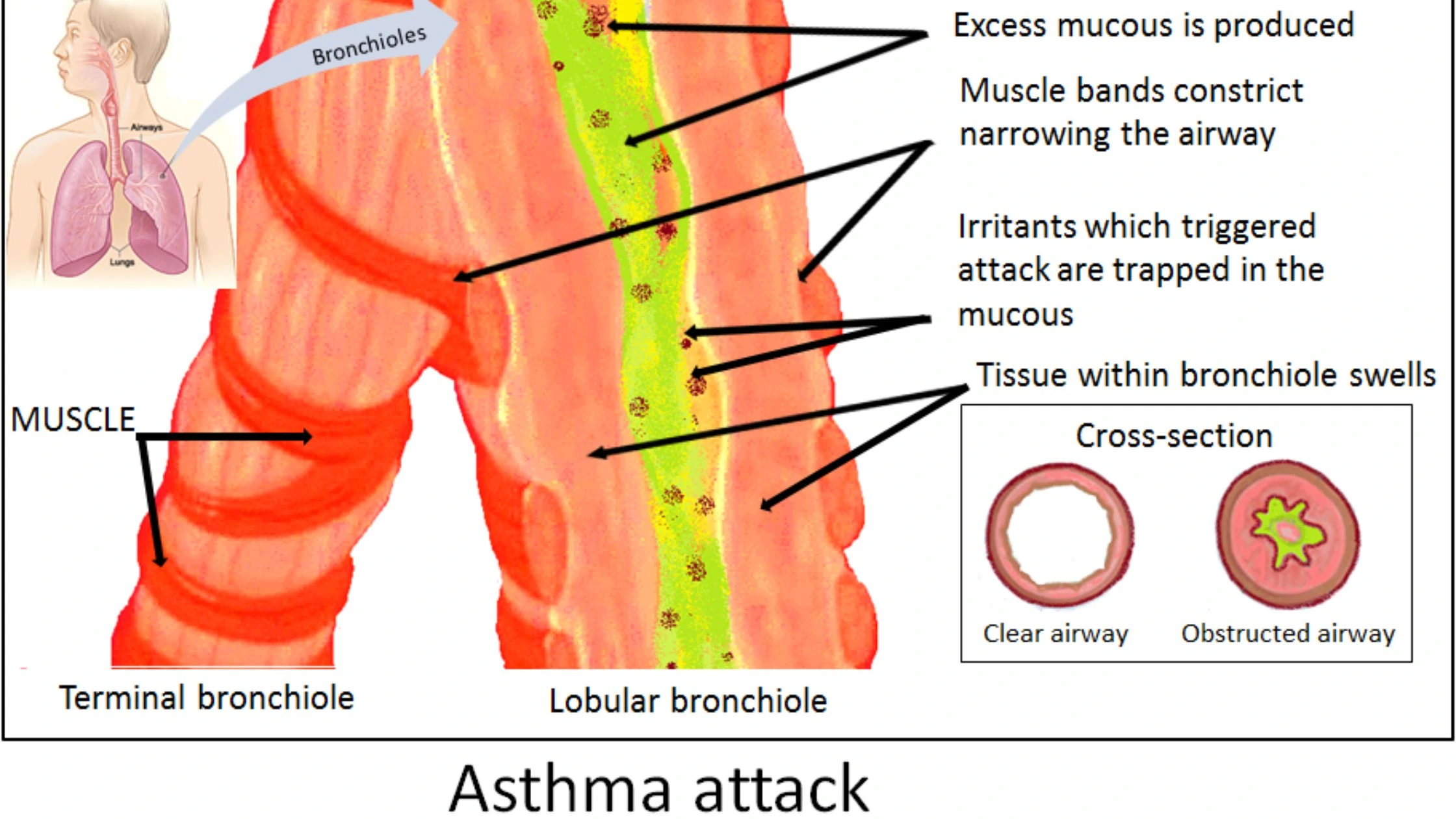 शीतलहर के बीच Asthma Attacks  से बचने के उपाय