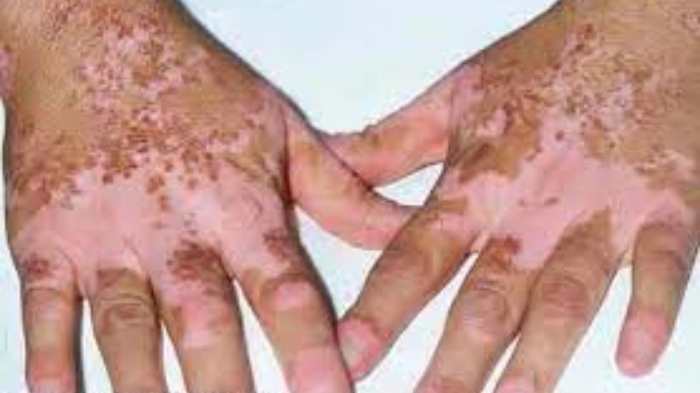 Vitiligo एक ऐसी स्थिति है जिसमें त्वचा कुछ क्षेत्रों में Pigmentation खो देती है, जिसके परिणामस्वरूप सफेद धब्बे हो जाते हैं। यह एक Autoimmune Disorder के कारण होता है और संक्रामक नहीं है।